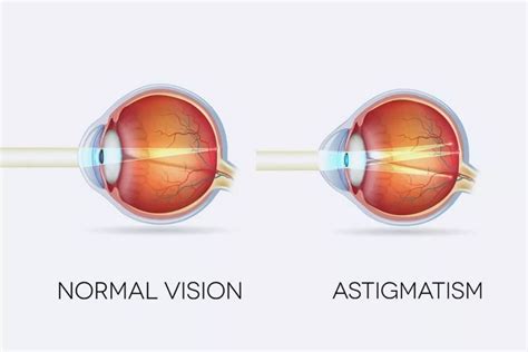 Astigmatism Eye Chart