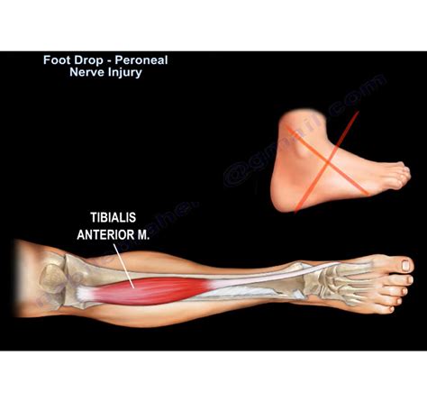 Foot Drop And Peroneal Nerve Injury —