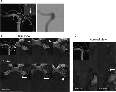 Evaluation Of The Arterial Wall In Vertebrobasilar Artery Dissection