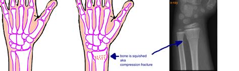 Kids Broken Forearm Both Bone Forearm Fracture — Bone Talks