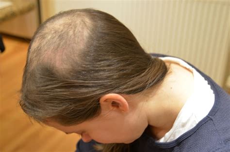 The Truth About Trichotillomania The Hair Pulling Disorder Cbc Life