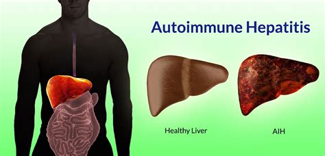 Autoimmune Hepatitis Causes Symptoms Life Expectancy And Treatment