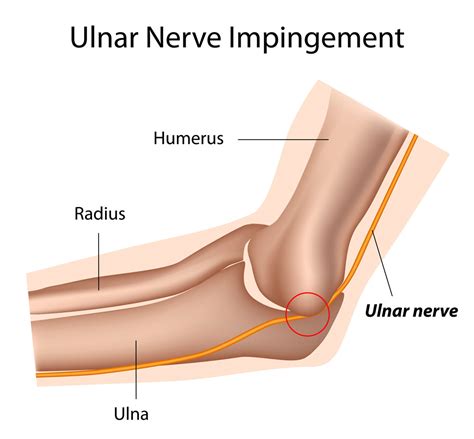 Elbow Ulnar Nerve Impingement The Orthopedic And Sports Medicine