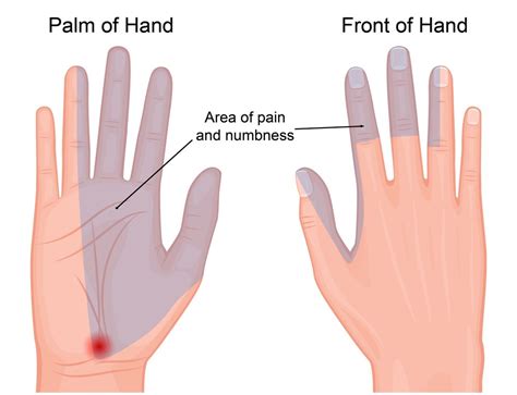 Those In The Hospital Carpal Tunnel Syndrome