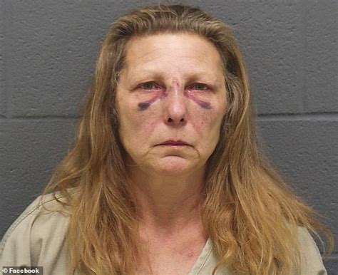 Woman Charged With Husbands Murder Is Pictured With Two Black Eyes