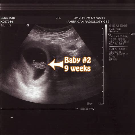 Can I See Your 8 9 Weeks Scans Please Babygaga