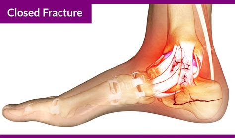Pin By Anja Stephan On Foot Dr Calcaneus Fracture Treatment