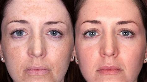 Melasma Before And After Laser And Skin
