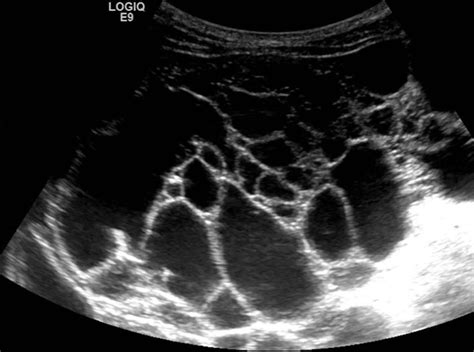 Compva Imaging — Lymphatic Malformation