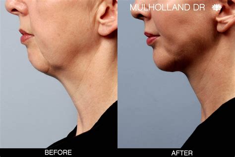 Chin Implants Before And After Photo Gallery Tps
