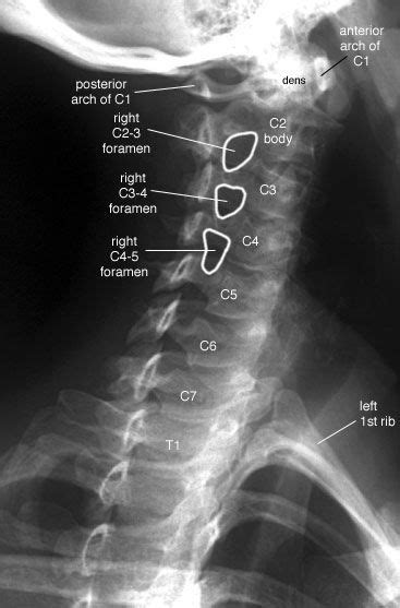 Cervical Spine Radiographs Oblique Cervical Spine Right Anterior