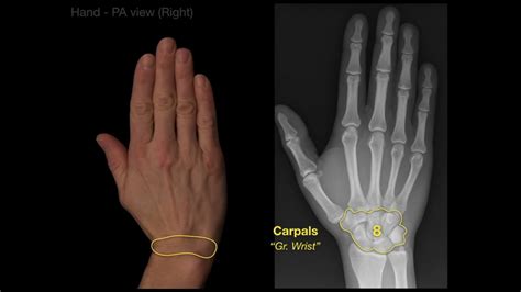 Anatomy Of Hand X Raysrevised Youtube