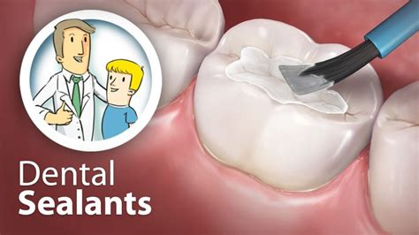 Dental Sealants Dental Sealants Sensitive Teeth Remedy Sensitive Teeth