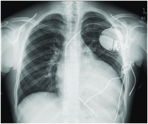 Anterior Posterior Ap Chest X Ray Showing Dual Chamber Icd With A