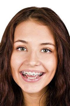 Pin By John Beeson On Girls In Braces Orthodontics Dentist Orthodontist