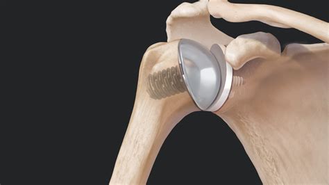 Arthrex Eclipse™ Stemless Shoulder Arthroplasty System