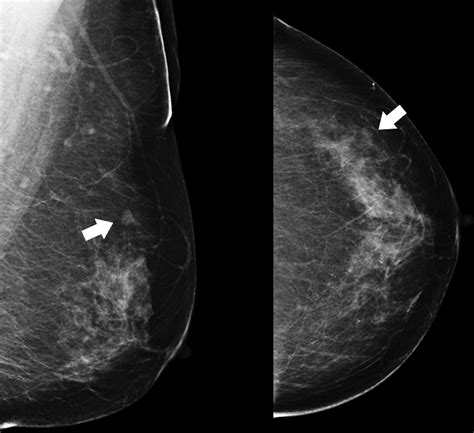 Asymmetric Mammographic Findings Based On The Fourth Edition Of Bi Rads