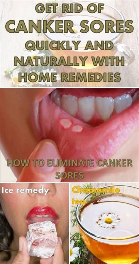 Get Rid Of Canker Sores Quickly And Naturally With Home Remedies