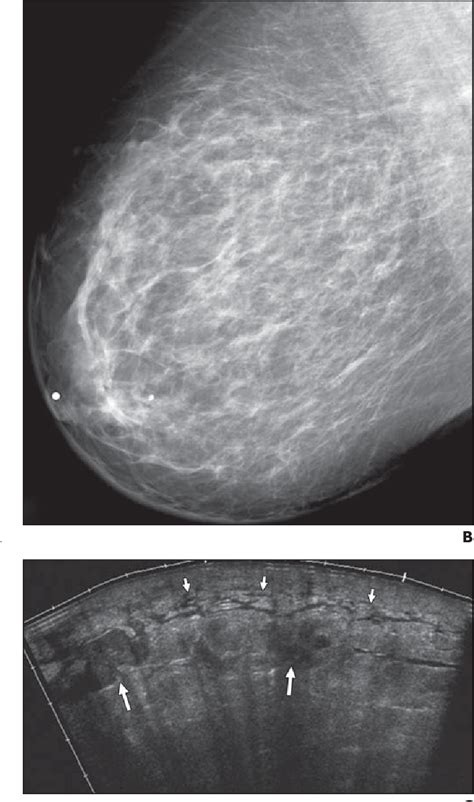 figure 4—67 from mri features of inflammatory breast cancer semantic scholar
