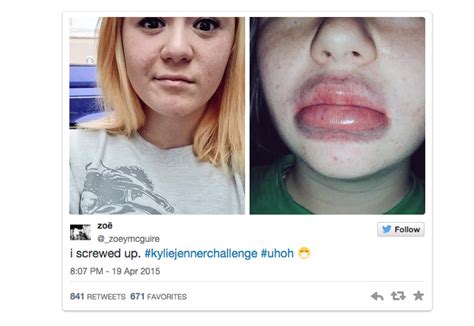 Kylie Jenner Addresses Scary Lipchallenge On Twitter Stylecaster