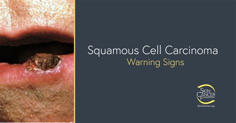 Squamous Cell Carcinoma Warning Signs And Images The Skin Cancer My Xxx Hot Girl