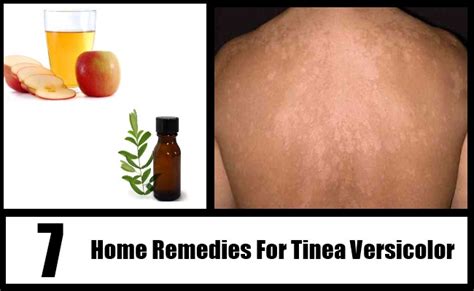 7 Tinea Versicolor Home Remedies Natural Treatmentsand Cure Search