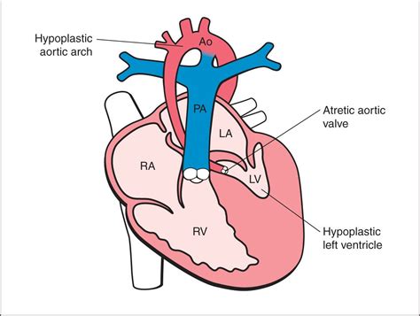 Hypoplastic Left Heart Syndrome And Critical Aortic Stenosis Obgyn