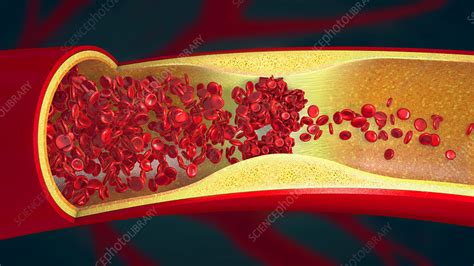 Blood Clot Illustration Stock Image F0304428 Science Photo Library