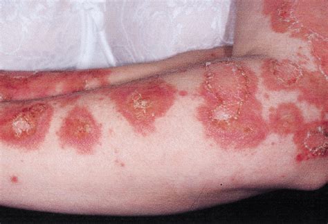 Frequency And Severity Of Systemic Disease In Patients With Subacute Cutaneous Lupus