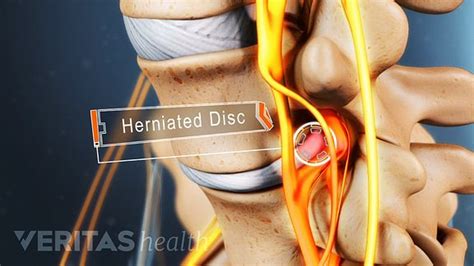 Lumbar Herniated Disc Symptoms Treatments And Surgery