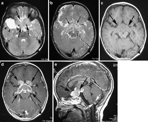 A Pilocytic Astrocytoma Involving Optic Pathways A An Axial
