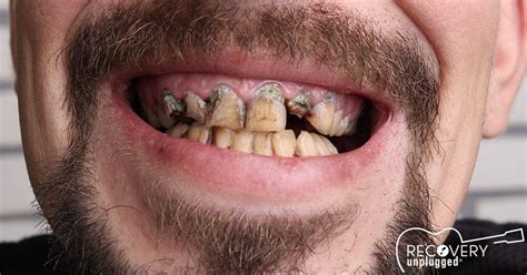 Why Do Meth Addicts Lose Their Teeth