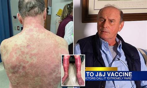 Virginia Mans Skin Peeled Off After Jandj Covid Vaccine Daily Mail