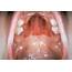 Oral Bleeding In Scurvy Photograph By Clinica Claros/science Photo Library