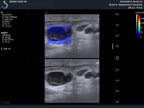 Vietnamese Medic Ultrasound Case 459 Cervical Lymph Nodes Dr Phan