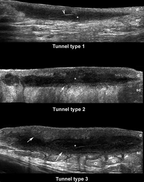 Imaging Techniques In Hidradenitis Suppurativa And Comorbidities