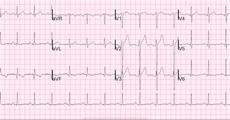 Dr Smiths Ecg Blog Anterior St Elevation Anterior Stemi A