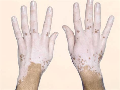 Vitiligo Is Caused By A Loss Of Pigment In The Skin Due To Destruction