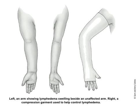 Pin On Lymphedema