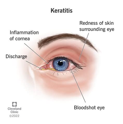 Keratitis Types Symptoms Treatment