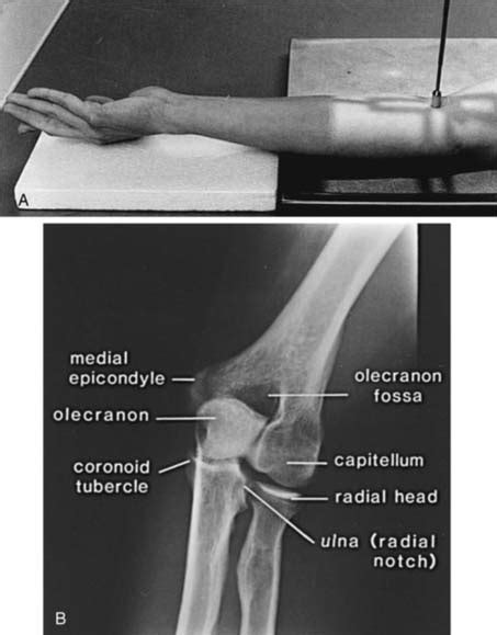 Diagnostic Imaging Of The Elbow Musculoskeletal Key