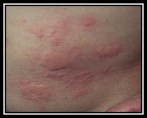 How Do You Get Scabies And What Does Scabies Look Like