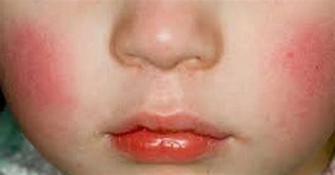 These Are The Symptoms Of Slapped Cheek Syndrome For Parents To Look