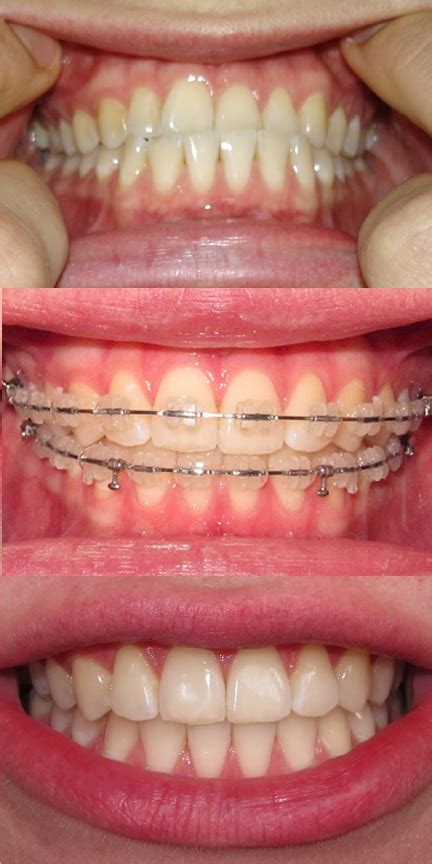Say Braces Underbite Fixed With Braces Only