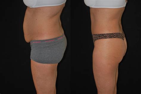 Tummy Tuck Abdominoplasty Before And After Salmon Creek Plastic Surgery