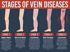 San Diego Varicose Vein Treatment - The Secret Vein Clinic in La Jolla, CA  Heart and Circulation Varicose Veins