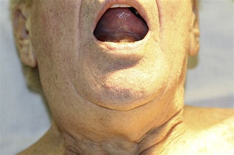 Angiotensin Converting Enzyme Inhibitor Angioedema Journal Of