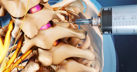 Epidural Steroid Injection Pain Relief Success Rates