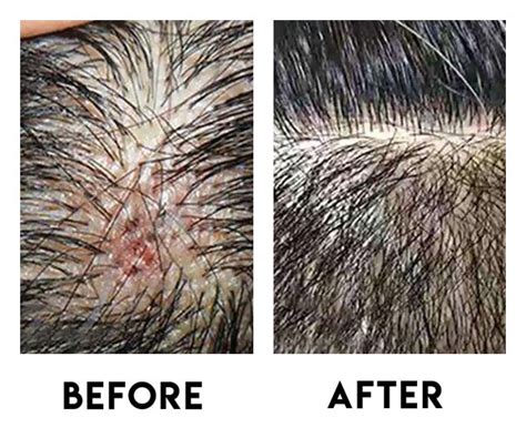 Scalp Acne Removal Treatment Singapore Try For 28