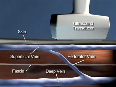 Rfa Perforator La Jolla Vein And Vascular Accredited Vein Center